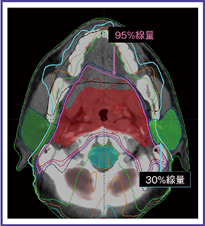 図1　頭頸部癌に対するIMRTの線量分布図