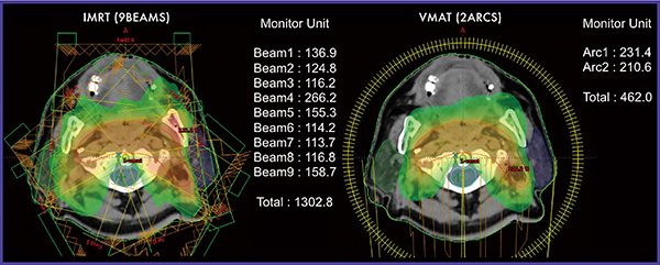 図1　上咽頭癌に対するIMRTとVMATの線量分布図と治療MUの一例
