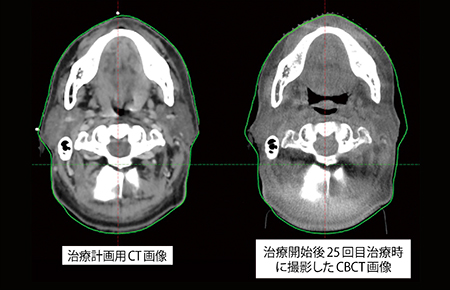 図3　治療計画用CT画像と治療開始後25回目のCBCT画像