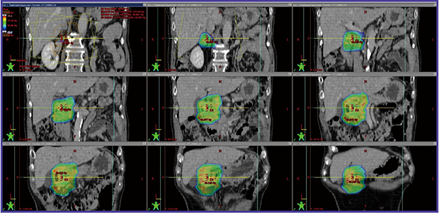 図1　‌症例1：十二指腸壁原発の孤立性形質細胞腫に対するRapidArcを用いたISRTの例