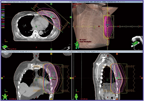 図2　乳房温存術後の放射線治療計画例