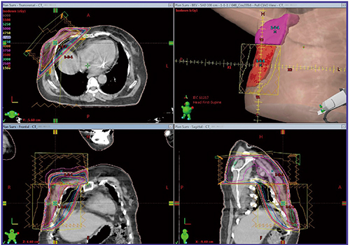 図3　乳房切除後の放射線治療計画例