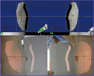 図1　計画照射形状（上段）および患者セットアップ画像（下段）