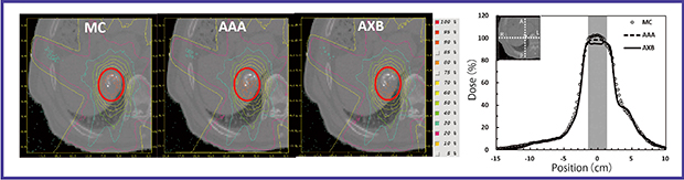 図5　リピオドールが残存した患者CT画像におけるモンテカルロ計算とEclipseの線量計算アルゴリズムであるAAA，AXBで計算した線量分布の比較