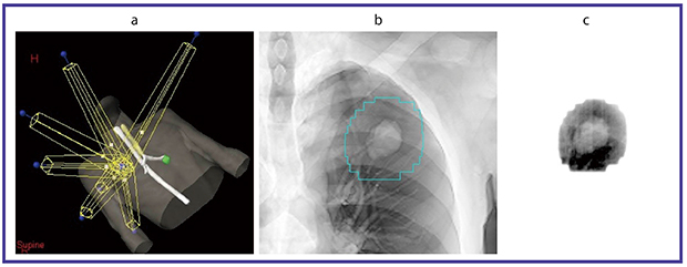 図1　RPMシステムによるSRTのmodel view（a），治療計画CTによるデジタル再構成画像（DRR）（b）と照射中のEPI像（後方からのportal image）（c） 症例は，70歳代，男性。右肺上葉の腺癌，T1aN0M0，IA期。non-coplanar 6門で48Gy/4回照射。