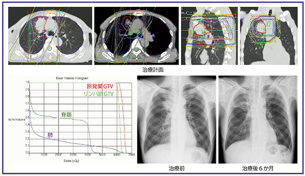図2　症例1：同時化学放射線療法例 60歳代，男性。右肺上葉S3原発の腺癌，cT2aN2M0，ⅢA期。