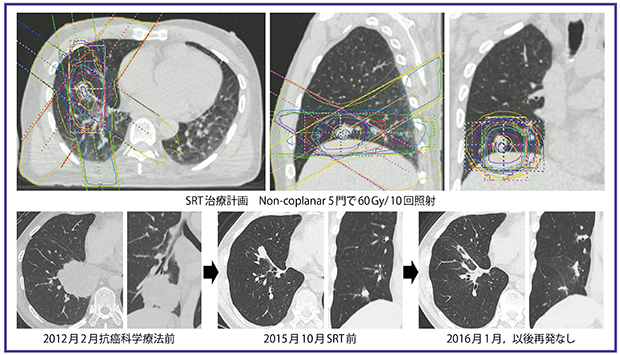 図3　症例2：oligo-progressionに対するSRTの例 60歳代，男性。右肺下葉原発の非小細胞肺癌（低分化で組織型不明），cT4N3M1b（脳），Ⅳ期で薬物療法後。 SRT治療計画はnon-coplanar 5門で60Gy/10回照射。
