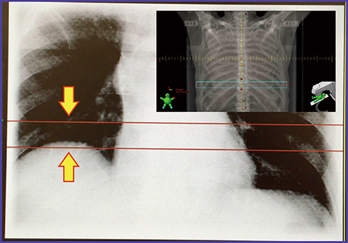 図4　患者セットアップ時の横隔膜運動の観察