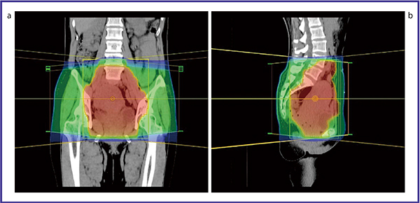 図1　症例1：子宮頸癌に対する全骨盤照射の放射線治療計画例　 a：冠状断像　b：矢状断像