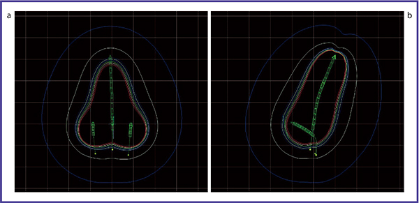 図2　症例1：子宮頸癌に対する高線量率腔内照射の放射線治療計画例 a：正面像　b：側面像