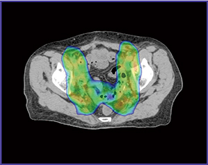 図3　症例2：RapidArcを用いた全骨盤照射の放射線治療計画例