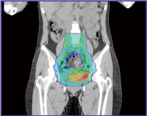 図4　症例3：RapidArcを用いた子宮頸癌術後再発に対する救済的放射線治療計画例