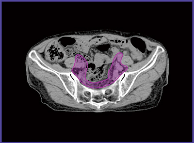 図1　子宮頸癌に対する全骨盤照射における臨床的標的体積描画例