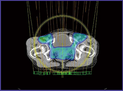 図2　RapidArcによる鼠径リンパ節領域を含む全骨盤照射の放射線治療計画例