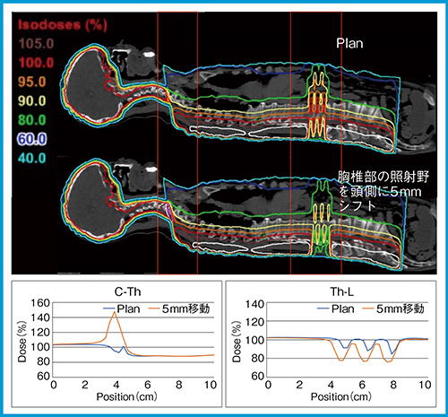 図2　従来法の全脳全脊髄照射の線量分布と照射野つなぎ目位置の線量プロファイル