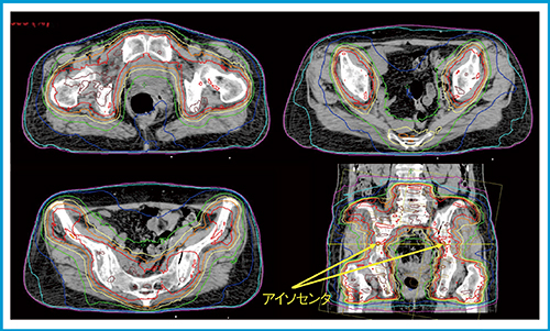 図5　骨盤2アイソセンタRapidArcの治療計画例