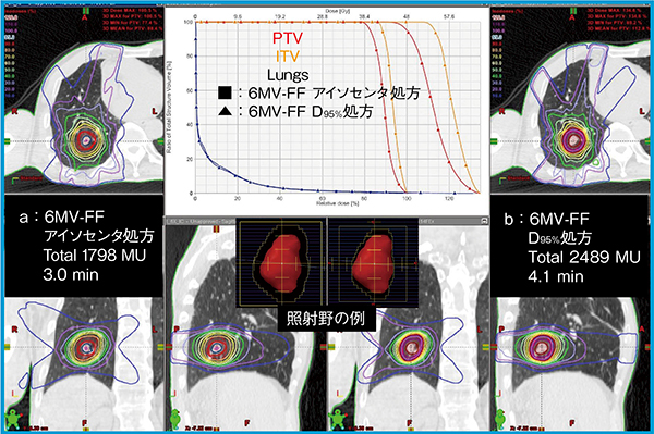 図2　肺がんSBRTにおけるアイソセンタ処方（a）とD95％処方（b）の違い