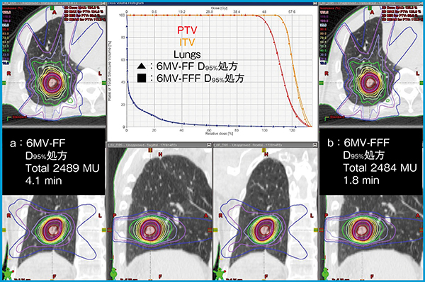 図3　肺がんSBRTにおけるFFビーム（a）とFFFビーム（b）の違い
