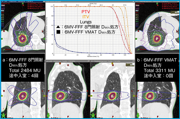 図4　肺がんSBRTにおける固定多門照射（a）とVMAT（b）の違い