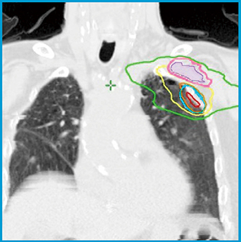 図3　左上葉肺腺癌1 病巣は腕神経叢に近接して存在する。PTVと計画リスク臓器体積（PRV）の最短距離は3mmであった。腕神経叢の最大線量は33Gy，それに3mmを付与したPRVの最大線量は41Gyであることを確認し，SBRTを行った。 ＊治療計画前に上肢挙上と下げた場合の2種類の体位でCTを撮影し，PTVとPRVがより離れている姿勢で治療計画を行う。 腕神経叢（○），PRV（＝腕神経叢＋3mm）（○），PTV（○），等線量曲線は外側より16.7Gy（○），33.3Gy（○），50Gy（＝処方線量）（○），66.7Gy（○）