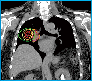 図5　右下葉転移性肺腫瘍 肺動脈と病巣が近接している。Timmermanらの定義によればcentral tumorである。しかし，PTVと肺動脈に3mm付与したPRVの最短距離が6mmであり，60Gy/5回（60％ isodose）の線量処方でも，PRVへの線量はほぼ40Gy以下（D2cc<40Gy），肺動脈への最大線量は40Gy未満である。そのため，60Gy/5回（60％ isodose処方）にてSBRTを行った。 肺動脈（○），肺動脈PRV（＋3mm）（○），GTV（○），PTV（○），等線量曲線は外側より20Gy（○），40Gy（○），60Gy（＝処方線量）（○），80Gy（○）