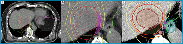 図2　肝細胞がんに対するSBRTの線量分布の一例（食道近接例） a，bは，初回治療時の多軌道回転原体照射＋固定照射による線量分布である。病巣が食道に近接しているため，食道への高線量照射を懸念して，食道近傍のPTVへの線量投与が不十分となった。この症例は1年を待たずに局所再発させてしまった。cはRapidArcにて再計画を行った線量分布図である。食道近傍まで高線量投与が可能である。この線量分布で照射をしていれば再発させないですんだかもしれない。悔やまれる症例である。 内側の○：GTV，○：PTV，等線量曲線は外側より10Gy（○），20Gy（○），30Gy（○），40Gy（○）（処方線量），45Gy（○）。