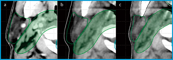 図2　SmartAdaptを用いたコンツールの貼り付け aは治療計画用CT，bは5週目の治療室内CTへコンツールをそのまま貼り付け，cはSmartAdaptを用いてコンツールを貼り付け。治療室内CTでは体輪郭および耳下腺が縮小しており，そのままの貼り付けではコンツールが体外へ飛び出している（b）。Smart Adaptを用いることで，変形に合わせたコンツールの貼り付けが可能となる（c）。
