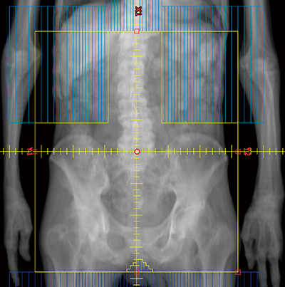 図1　腰椎〜骨盤に対する半身照射 target volumeは設定せず，数値入力でマルチリーフコリメータ（MLC）を設定し両腎と消化器を遮蔽している。