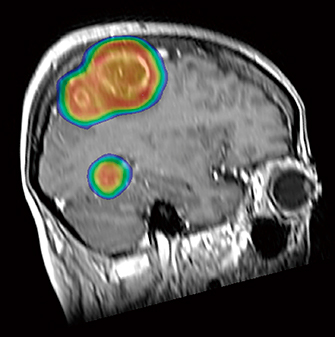 図3　多発性脳転移に対する定位的IMRT 4個の脳転移巣（そのうち2個は隣接）を含む1つのplanning target volume（PTV）を設定し，4個の脳転移巣を3分で治療し得た。