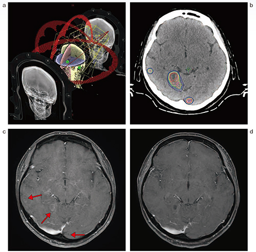 図2　HyperArcでの治療の一例（肺がん・脳転移） a：4アークでのHyperArc b：線量分布図 c：治療前のMRI（ガドリニウム造影T1強調画像） d：治療終了5か月後のMRI（ガドリニウム造影T1強調画像） PTV-D98％，35Gy/5回の治療を12か所に行った例。5か月後のMRIで病変の縮小，消失および内部の壊死が認められた。