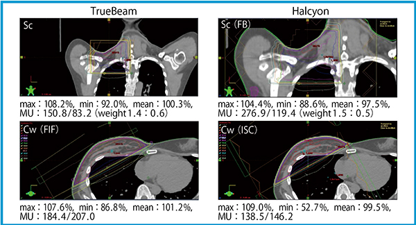 図5　鎖骨上窩リンパ節を含む乳房照射の治療計画（TrueBeam vs. Halcyon） 鎖骨上窩リンパ節に対しては前後対向2門照射，乳房に対しては接線照射をISCにて作成Sc：鎖骨上窩リンパ節，Cw：胸壁