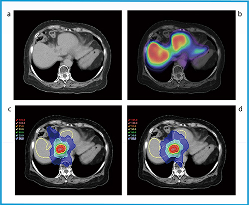 図1　アシアロスペクト画像を用いたinverse planningによる肝機能温存定位放射線治療の例