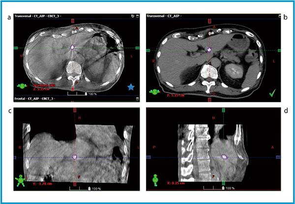 図2　放射線治療計画用CT画像とCBCT画像による金マーカーを用いた画像誘導放射線治療の例