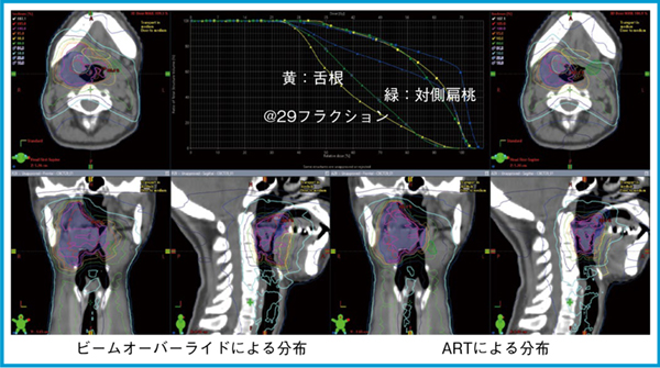 図1　腫瘤縮小を生じた中咽頭癌：ビームオーバーライドによる線量分布と適応放射線治療による線量分布の比較