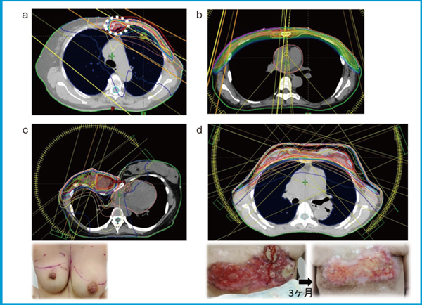図1　VMATを用いたプランの一例 a：SIB-VMAT（IMNへのブースト）　b：両側IMNを含む乳房全切除後放射線治療（PMRT） c：漏斗胸の患者，腫瘍床ブースト　d：両側に広がる局所進行乳がんへの照射