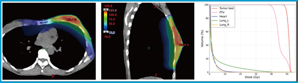 図1　左側乳がんに対する SIB-VMAT プランの線量分布図とDVH partial arcsにより心臓・肺への線量を抑制しつつ，全乳房と腫瘍床への良好な線量分布が得られている。