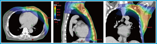 図2　鎖骨上・腋窩リンパ節領域へのVMATを用いた線量分布図 胸壁と鎖骨上領域の接合部に対しても均一な線量分布が確認できる。