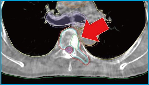 図2　椎体定位照射におけるHyperSight CBCT画像 （ストラクチャー含む，GTV＝緑色のライン）