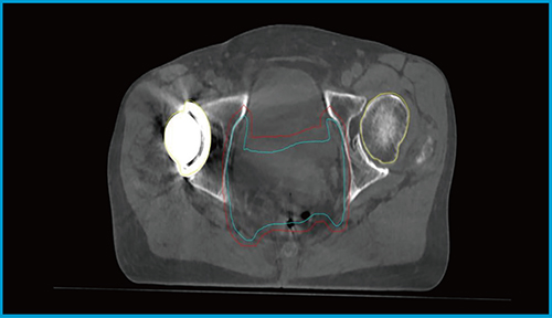 図3　金属インプラント（人工骨頭）が挿入された子宮頸がんにおけるIMRT実施時の HyperSight CBCT画像（ストラクチャー含む）