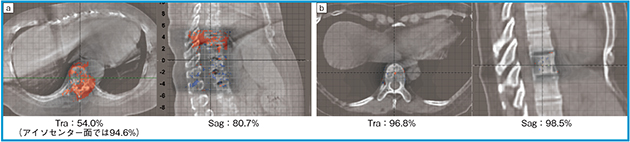 図3　HS-CBCT画像とガンマ解析（1%/1mm, threshold 80%）のマージ画像（Traは横隔膜レベル）およびガンマパス率 a：自然呼吸下　b：固定シェルを用いた腹部圧迫による呼吸抑制下