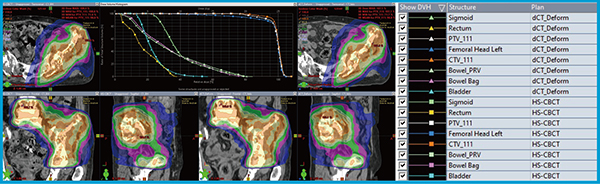図5　症例2におけるHS-CBCT（左）とdCT（右）の線量分布の比較