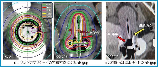 図3　Air gapを生じた症例