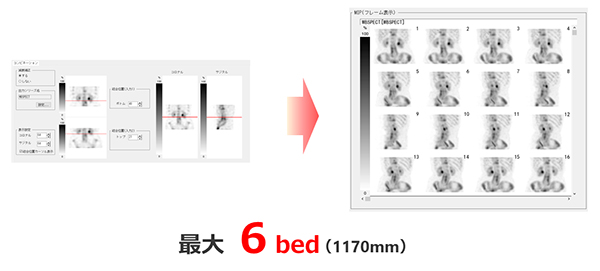 ホールボディSPECT