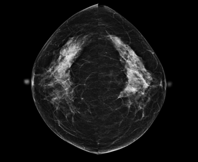 間接変換方式（CsI）76μmの高解像度FPDを搭載