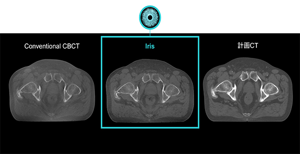 高精細CBCT「Iris」による画像誘導