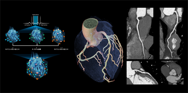 左　SnapShot Freeze2.0の概念図 ターゲット心位相とその前後の心位相の合計3心位相のフェーズデータを用いて，心臓を構成する各ボクセルの動態を3次元的にベクトル解析し，変化量をフィードバックし静止画像を生成 右　70kV, 0.23秒/回転で撮影した心臓CT画像