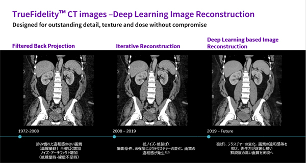 Deep learningを用いた画像再構成アルゴリズム　TrueFidelity™ Imaging