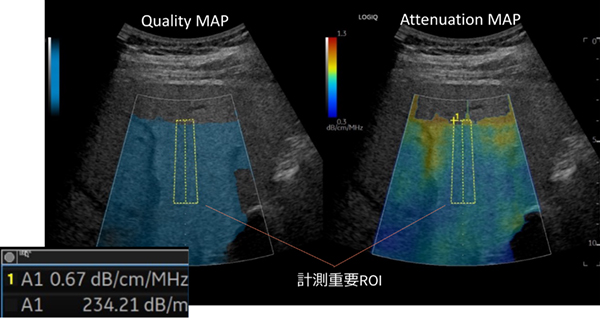 Ultrasound-guided attenuation parameter（UGAP）