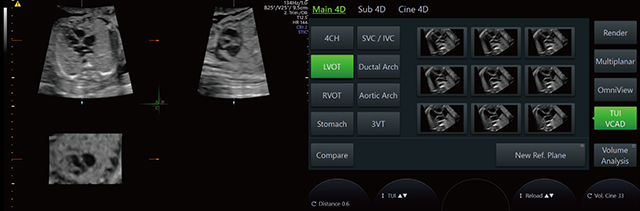 心臓検査を高精度に「Fetal Heart Imaging」