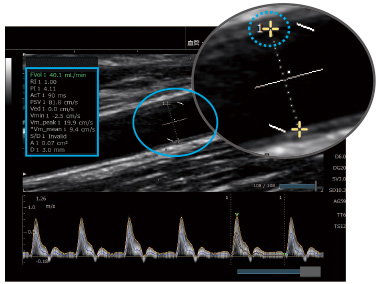 血流測定を簡単にVascular NAVI